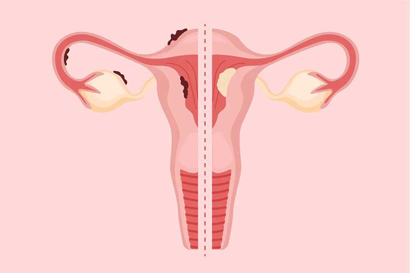 Endometriosis