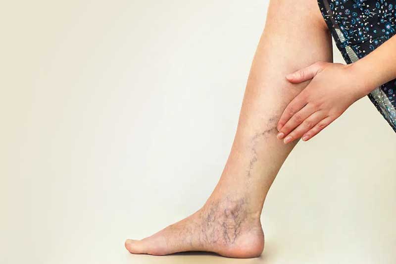 Varicose Vein and Varicose Ulcer Treatment
