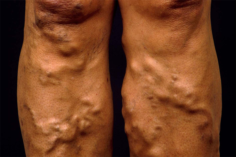 Varicose Vein and Varicose Ulcer Treatment